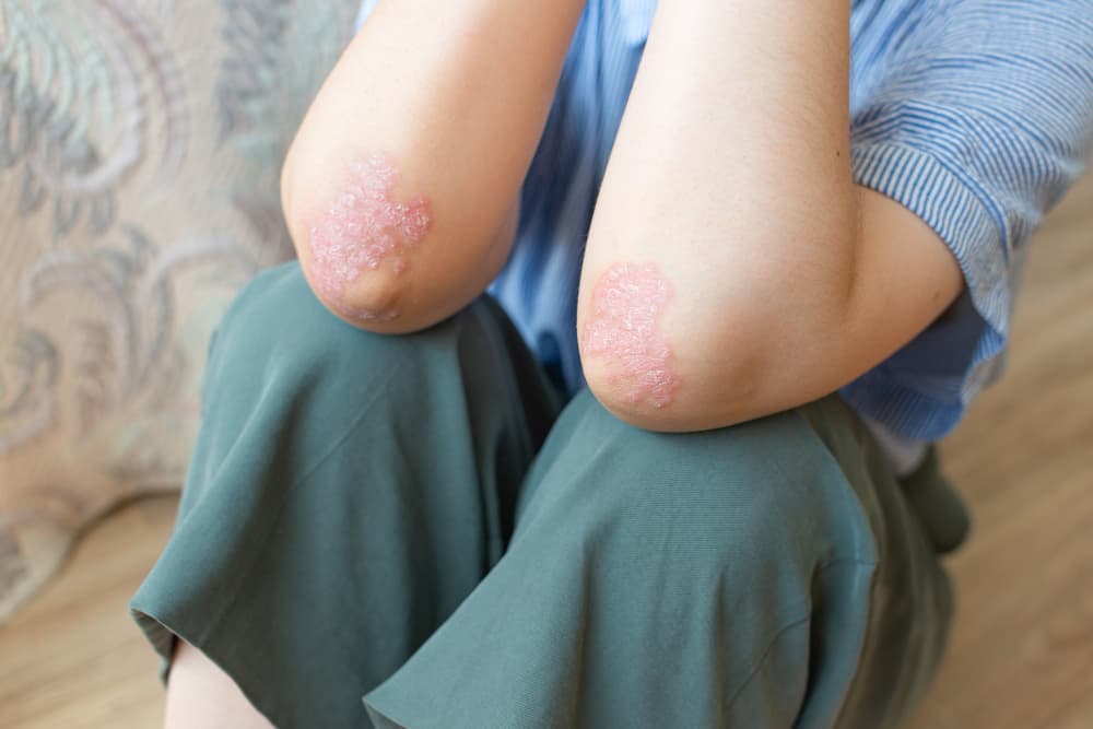 Fungal Infections in Humid Weather: Why Skin Rashes Increase During Summer and Monsoon